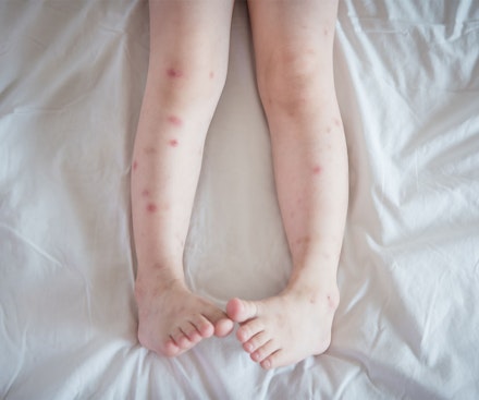 لدغات بق الفراش على أرجل الإنسان