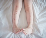 Bed Bug Bites on human legs